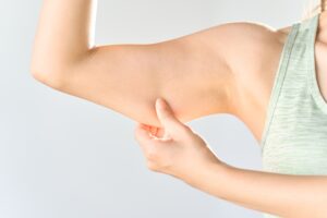 Arm Lift (Brachioplasty)