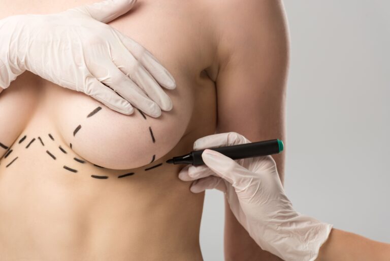 Breast Lift (Mastopexy)