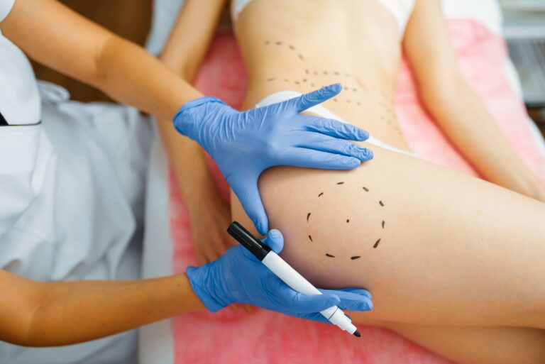 High-Definition Liposuction (Body Sculpting)