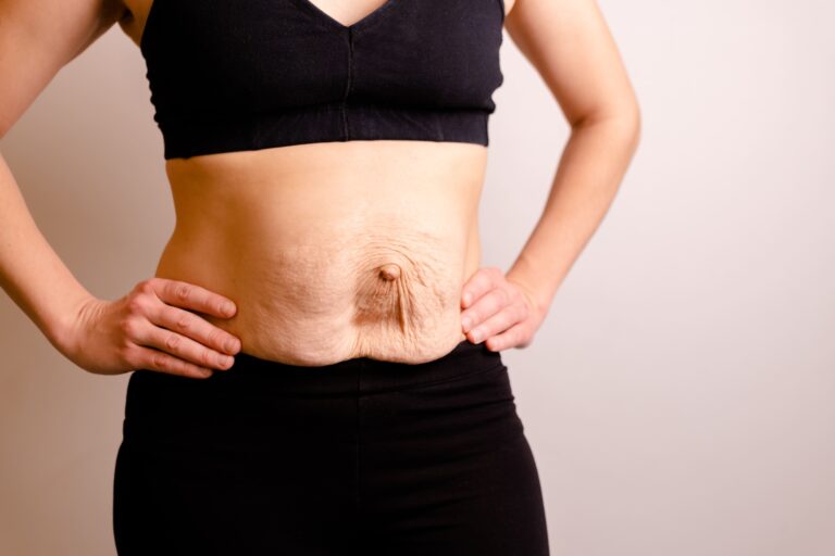 Tummy Tuck (Abdominoplasty)