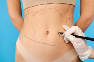 Liposuction